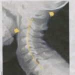 Text Neck?